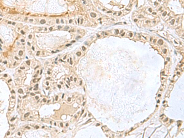 KDM3B / JMJD1B Antibody - Immunohistochemistry of paraffin-embedded Human thyroid cancer tissue  using KDM3B Polyclonal Antibody at dilution of 1:45(×200)