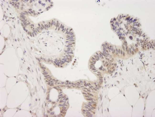 KDM4A / JHDM3A / JMJD2A Antibody - Detection of Human JMJD2A by Immunohistochemistry. Sample: FFPE section of human ovarian tumor. Antibody: Affinity purified rabbit anti-JMJD2A used at a dilution of 1:250.