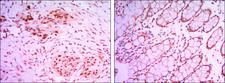 KDM4A / JHDM3A / JMJD2A Antibody - IHC of paraffin-embedded colon cancer tissues (left) and human larynx cancer tissues (right) using KDM4A mouse monoclonal antibody with DAB staining.