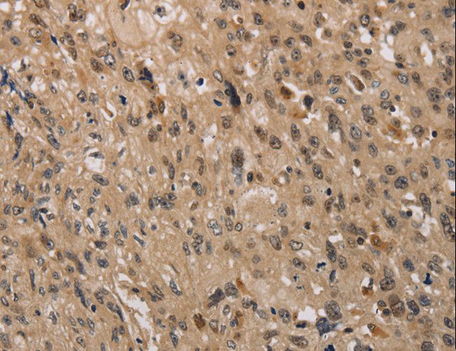 KDM4A / JHDM3A / JMJD2A Antibody - Immunohistochemistry of paraffin-embedded Human esophagus cancer using KDM4A Polyclonal Antibody at dilution of 1:40.