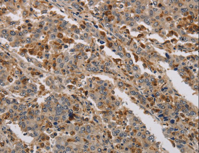 KDM4A / JHDM3A / JMJD2A Antibody - Immunohistochemistry of paraffin-embedded Human liver cancer using KDM4A Polyclonal Antibody at dilution of 1:40.