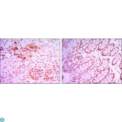 KDM4A / JHDM3A / JMJD2A Antibody - Immunohistochemistry (IHC) analysis of paraffin-embedded colon cancer tissues (left) and human larynx cancer tissues (right) with DAB staining using JMJD2A Monoclonal Antibody.