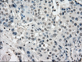 KDM4C / JMJD2C Antibody - Immunohistochemical staining of paraffin-embedded Adenocarcinoma of breast tissue using anti-KDM4C mouse monoclonal antibody. (Dilution 1:50).
