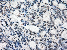KDM4C / JMJD2C Antibody - Immunohistochemical staining of paraffin-embedded Adenocarcinoma of colon tissue using anti-KDM4C mouse monoclonal antibody. (Dilution 1:50).
