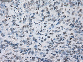 KDM4C / JMJD2C Antibody - Immunohistochemical staining of paraffin-embedded Adenocarcinoma of ovary tissue using anti-KDM4C mouse monoclonal antibody. (Dilution 1:50).