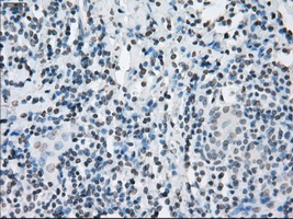 KDM4C / JMJD2C Antibody - Immunohistochemical staining of paraffin-embedded Carcinoma of thyroid tissue using anti-KDM4C mouse monoclonal antibody. (Dilution 1:50).