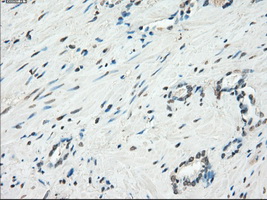 KDM4C / JMJD2C Antibody - Immunohistochemical staining of paraffin-embedded Carcinoma of prostate tissue using anti-KDM4C mouse monoclonal antibody. (Dilution 1:50).