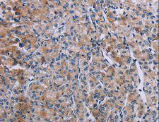 KDM4D / JMJD2D Antibody - Immunohistochemistry of paraffin-embedded Human prostate cancer using KDM4D Polyclonal Antibody at dilution of 1:60.