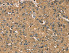KDM5A / JARID1A Antibody - Immunohistochemistry of paraffin-embedded Human liver cancer using KDM5A Polyclonal Antibody at dilution of 1:45.