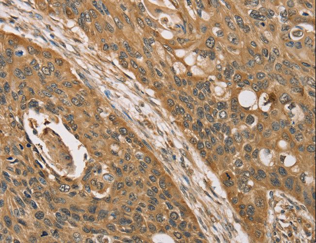 KDM5A / JARID1A Antibody - Immunohistochemistry of paraffin-embedded Human esophagus cancer using KDM5A Polyclonal Antibody at dilution of 1:45.
