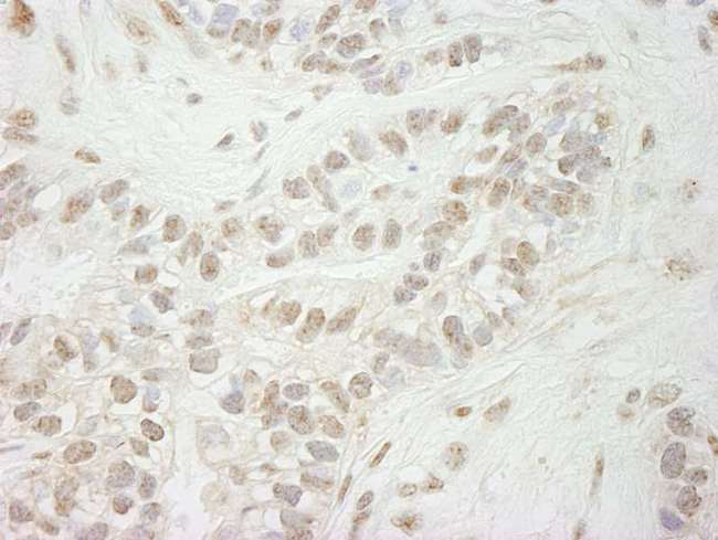 KDM5B / JARID1B Antibody - Detection of Human Jarid1B by Immunohistochemistry. Sample: FFPE section of human breast carcinoma. Antibody: Affinity purified rabbit anti-Jarid1B used at a dilution of 1:250.