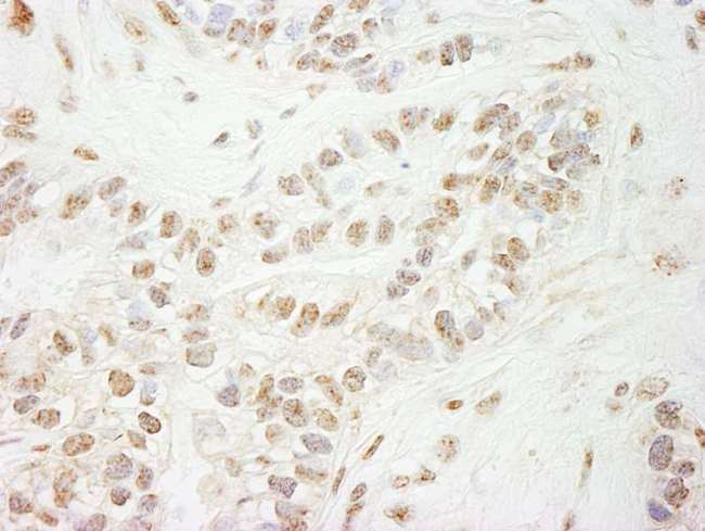 KDM5B / JARID1B Antibody - Detection of Human Jarid1B by Immunohistochemistry. Sample: FFPE section of human breast carcinoma. Antibody: Affinity purified rabbit anti-Jarid1B used at a dilution of 1:1000 (1 ug/ml). Detection: DAB.