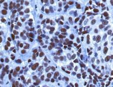 KDM5B / JARID1B Antibody - Immunohistochemistry: JARID1B Antibody - IHC analysis of JARID1B in human breast cancer xenograft using DAB with hematoxylin counterstain.  This image was taken for the unconjugated form of this product. Other forms have not been tested.