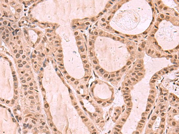 KDM7A / JHDM1D Antibody - Immunohistochemistry of paraffin-embedded Human thyroid cancer tissue  using KDM7A Polyclonal Antibody at dilution of 1:35(×200)