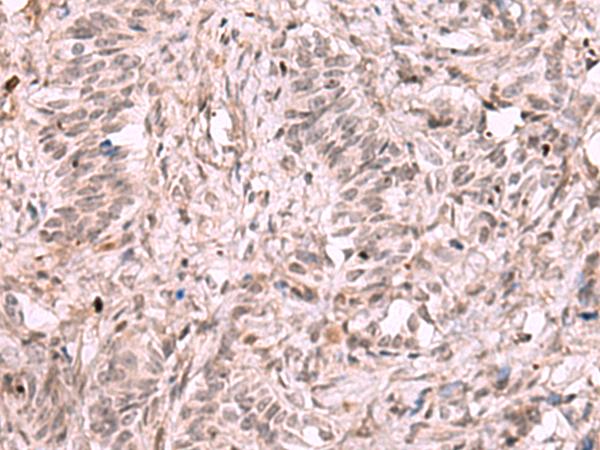 KDM7A / JHDM1D Antibody - Immunohistochemistry of paraffin-embedded Human ovarian cancer tissue  using KDM7A Polyclonal Antibody at dilution of 1:35(×200)