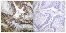 KDR / VEGFR2 / FLK1 Antibody - Immunohistochemistry analysis of paraffin-embedded human lung carcinoma tissue, using VEGFR2 Antibody. The picture on the right is blocked with the synthesized peptide.