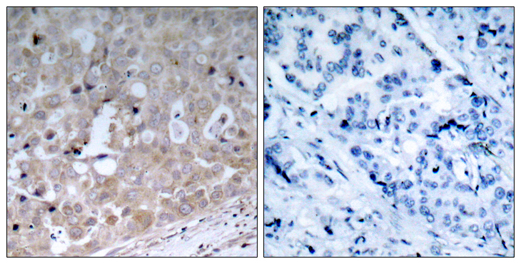 KDR / VEGFR2 / FLK1 Antibody - Immunohistochemistry analysis of paraffin-embedded human breast carcinoma tissue, using VEGFR2 Antibody. The picture on the right is blocked with the synthesized peptide.