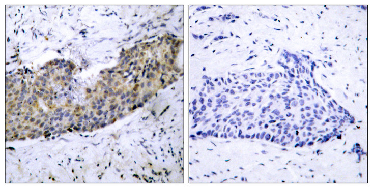 KDR / VEGFR2 / FLK1 Antibody - Immunohistochemistry analysis of paraffin-embedded human breast carcinoma tissue, using VEGFR2 Antibody. The picture on the right is blocked with the synthesized peptide.