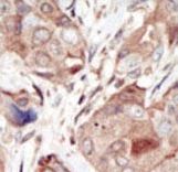 KDR / VEGFR2 / FLK1 Antibody - Formalin-fixed and paraffin-embedded human cancer tissue reacted with the primary antibody, which was peroxidase-conjugated to the secondary antibody, followed by DAB staining. This data demonstrates the use of this antibody for immunohistochemistry; clinical relevance has not been evaluated. BC = breast carcinoma; HC = hepatocarcinoma.
