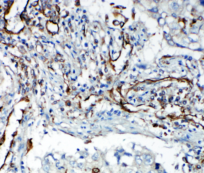 KDR / VEGFR2 / FLK1 Antibody - KDR / VEGFR2 antibody. IHC(P): Human Lung Cancer Tissue.