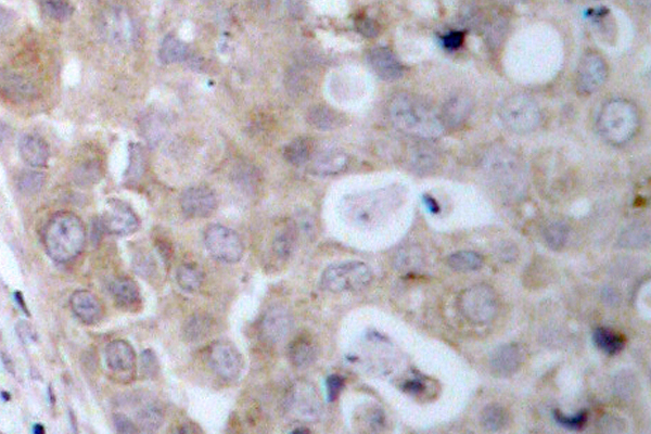 KDR / VEGFR2 / FLK1 Antibody - IHC of VEGFR2 (D1209) pAb in paraffin-embedded human breast carcinoma tissue.