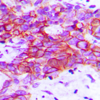 KDR / VEGFR2 / FLK1 Antibody - Immunohistochemical analysis of VEGFR2 staining in human breast cancer formalin fixed paraffin embedded tissue section. The section was pre-treated using heat mediated antigen retrieval with sodium citrate buffer (pH 6.0). The section was then incubated with the antibody at room temperature and detected using an HRP conjugated compact polymer system. DAB was used as the chromogen. The section was then counterstained with hematoxylin and mounted with DPX.