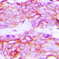 KDR / VEGFR2 / FLK1 Antibody - Immunohistochemical analysis of VEGFR2 (pY1214) staining in human breast cancer formalin fixed paraffin embedded tissue section. The section was pre-treated using heat mediated antigen retrieval with sodium citrate buffer (pH 6.0). The section was then incubated with the antibody at room temperature and detected using an HRP polymer system. DAB was used as the chromogen. The section was then counterstained with hematoxylin and mounted with DPX.