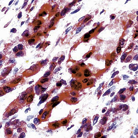 KDR / VEGFR2 / FLK1 Antibody - Formalin-fixed, paraffin-embedded human angiosarcoma stained with Flk-1 antibody.