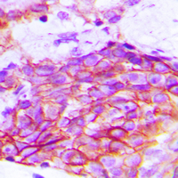 KDR / VEGFR2 / FLK1 Antibody - Immunohistochemical analysis of VEGFR2 staining in human breast cancer formalin fixed paraffin embedded tissue section. The section was pre-treated using heat mediated antigen retrieval with sodium citrate buffer (pH 6.0). The section was then incubated with the antibody at room temperature and detected using an HRP conjugated compact polymer system. DAB was used as the chromogen. The section was then counterstained with hematoxylin and mounted with DPX.