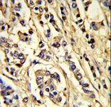 KDR / VEGFR2 / FLK1 Antibody - Formalin-fixed and paraffin-embedded human breast carcinoma reacted with VGFR2 Antibody, which was peroxidase-conjugated to the secondary antibody, followed by DAB staining. This data demonstrates the use of this antibody for immunohistochemistry; clinical relevance has not been evaluated.