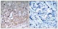 KDR / VEGFR2 / FLK1 Antibody - IHC of VEGFR2 antibody. Immunohistochemical analysis of paraffin-embedded human breast carcinoma tissue using VEGFR2 antibody (left) or the same antibody preincubated with with blocking peptide (right)