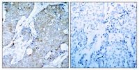 KDR / VEGFR2 / FLK1 Antibody - IHC of VEGFR2 antibody. Immunohistochemical analysis of paraffin-embedded human breast carcinoma tissue using VEGFR2 antibody (left) or the same antibody preincubated with with blocking peptide (right)