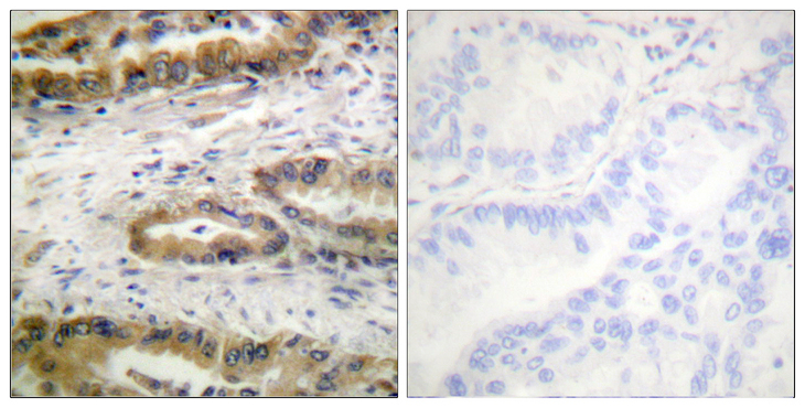 KDR / VEGFR2 / FLK1 Antibody - Immunohistochemistry analysis of paraffin-embedded human lung carcinoma, using VEGFR2 (Phospho-Tyr1054) Antibody. The picture on the right is blocked with the phospho peptide.