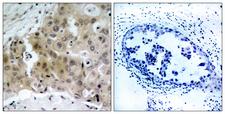 KDR / VEGFR2 / FLK1 Antibody - Immunohistochemistry analysis of paraffin-embedded human breast carcinoma, using VEGFR2 (Phospho-Tyr1175) Antibody. The picture on the right is blocked with the phospho peptide.