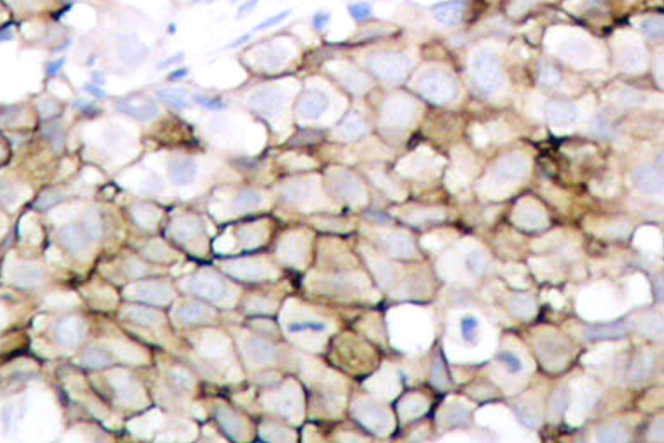 KDR / VEGFR2 / FLK1 Antibody - Immunohistochemistry analysis (IHC) analysis of p-Flk-1 (Y1175)pAb in paraffin-embedded human breast carcinoma tissue.