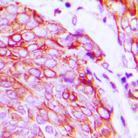 KDR / VEGFR2 / FLK1 Antibody - Immunohistochemical analysis of VEGFR2 (pY1175) staining in human breast cancer formalin fixed paraffin embedded tissue section. The section was pre-treated using heat mediated antigen retrieval with sodium citrate buffer (pH 6.0). The section was then incubated with the antibody at room temperature and detected using an HRP conjugated compact polymer system. DAB was used as the chromogen. The section was then counterstained with hematoxylin and mounted with DPX.