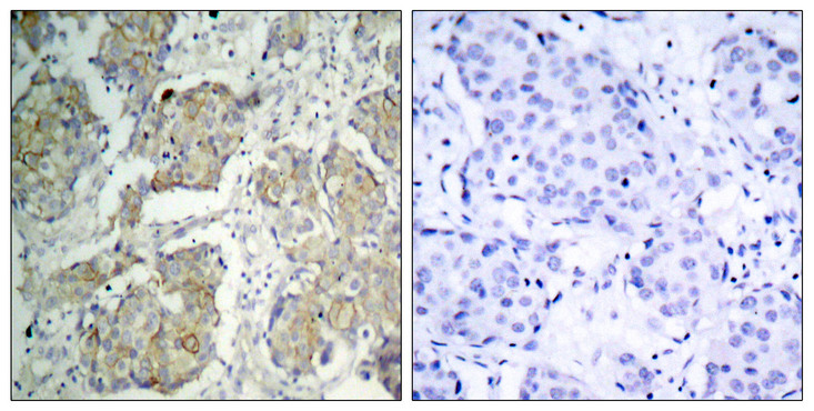KDR / VEGFR2 / FLK1 Antibody - Immunohistochemistry analysis of paraffin-embedded human breast carcinoma, using VEGFR2 (Phospho-Tyr1214) Antibody. The picture on the right is blocked with the phospho peptide.