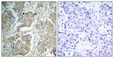KDR / VEGFR2 / FLK1 Antibody - Immunohistochemistry analysis of paraffin-embedded human breast carcinoma, using VEGFR2 (Phospho-Tyr1214) Antibody. The picture on the right is blocked with the phospho peptide.