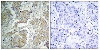 KDR / VEGFR2 / FLK1 Antibody - IHC of VEGFR2 antibody. Immunohistochemical analysis of paraffin-embedded human breast carcinoma tissue using VEGFR2 (Phospho-Tyr1214) antibody (left) or the same antibody preincubated with with blocking peptide (right)