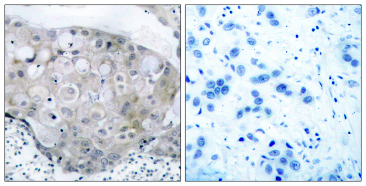 KDR / VEGFR2 / FLK1 Antibody - Immunohistochemistry analysis of paraffin-embedded human breast carcinoma, using VEGFR2 (Phospho-Tyr951) Antibody. The picture on the right is blocked with the phospho peptide.