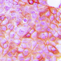 KDR / VEGFR2 / FLK1 Antibody - Immunohistochemical analysis of VEGFR2 (pY951) staining in human breast cancer formalin fixed paraffin embedded tissue section. The section was pre-treated using heat mediated antigen retrieval with sodium citrate buffer (pH 6.0). The section was then incubated with the antibody at room temperature and detected using an HRP conjugated compact polymer system. DAB was used as the chromogen. The section was then counterstained with hematoxylin and mounted with DPX.