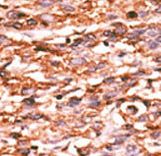 KDR / VEGFR2 / FLK1 Antibody - Formalin-fixed and paraffin-embedded human cancer tissue reacted with the primary antibody, which was peroxidase-conjugated to the secondary antibody, followed by AEC staining. This data demonstrates the use of this antibody for immunohistochemistry; clinical relevance has not been evaluated. BC = breast carcinoma; HC = hepatocarcinoma.