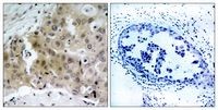 KDR / VEGFR2 / FLK1 Antibody - IHC of VEGFR2 antibody. Immunohistochemical analysis of paraffin-embedded human breast carcinoma tissue using VEGFR2 (Phospho-Tyr1175) antibody (left) or the same antibody preincubated with with blocking peptide (right)