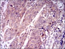 KEAP1 Antibody - IHC of paraffin-embedded bladder cancer tissues using KEAP1 mouse monoclonal antibody with DAB staining.
