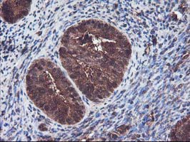 KEAP1 Antibody - IHC of paraffin-embedded Adenocarcinoma of Human endometrium tissue using anti-KEAP1 mouse monoclonal antibody.