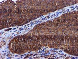 KEAP1 Antibody - IHC of paraffin-embedded Carcinoma of Human bladder tissue using anti-KEAP1 mouse monoclonal antibody.