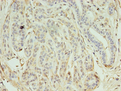 KEAP1 Antibody - Immunohistochemistry of paraffin-embedded human breast cancer using KEAP1 Antibody at dilution of 1:100
