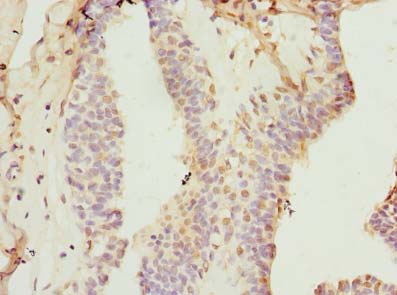 KEL / CD238 Antibody - Immunohistochemistry of paraffin-embedded human breast cancer using antibody at dilution of 1:100.