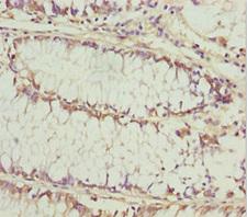 KERA / Keratocan Antibody - Immunohistochemistry of paraffin-embedded human colon cancer at dilution 1:100