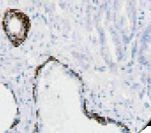 Keratin, HMW Antibody - IVD 1HCofCK W 34 12 on a FFPE Prostatic Adenocarcinoma.